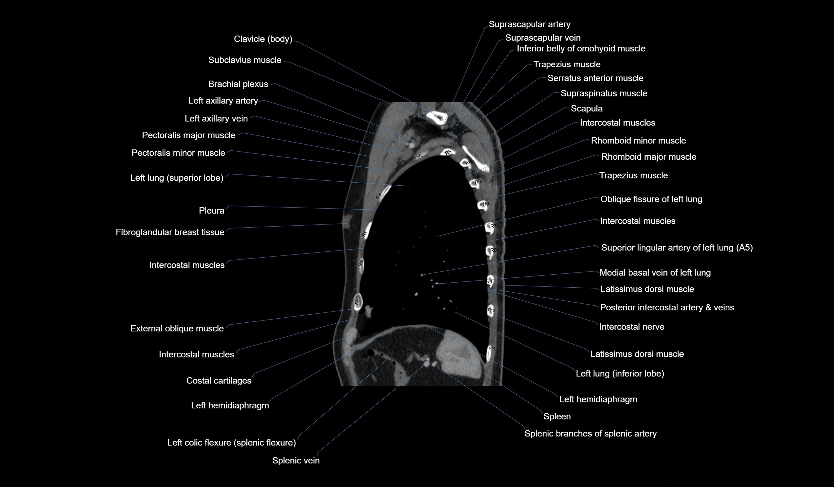 CT chest (thorax) soft tissue window labelled sagittal cross sectional anatomy radiology image-00113.webp